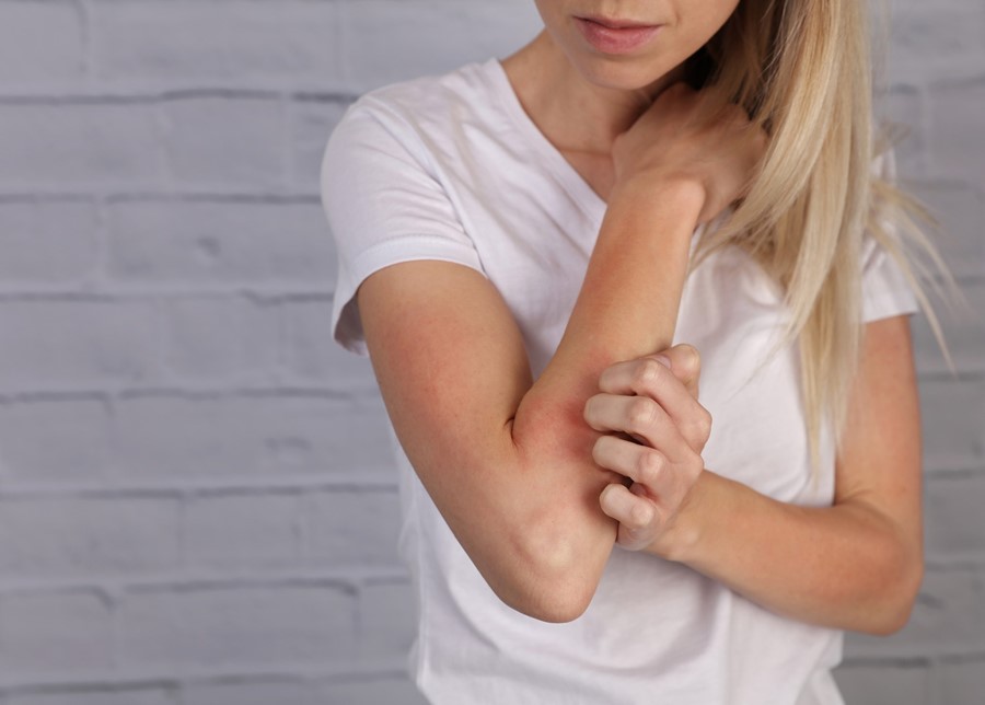 Do You Suffer With Eczema?