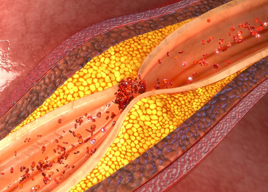 Cholesterol – Is It Such a Villain?